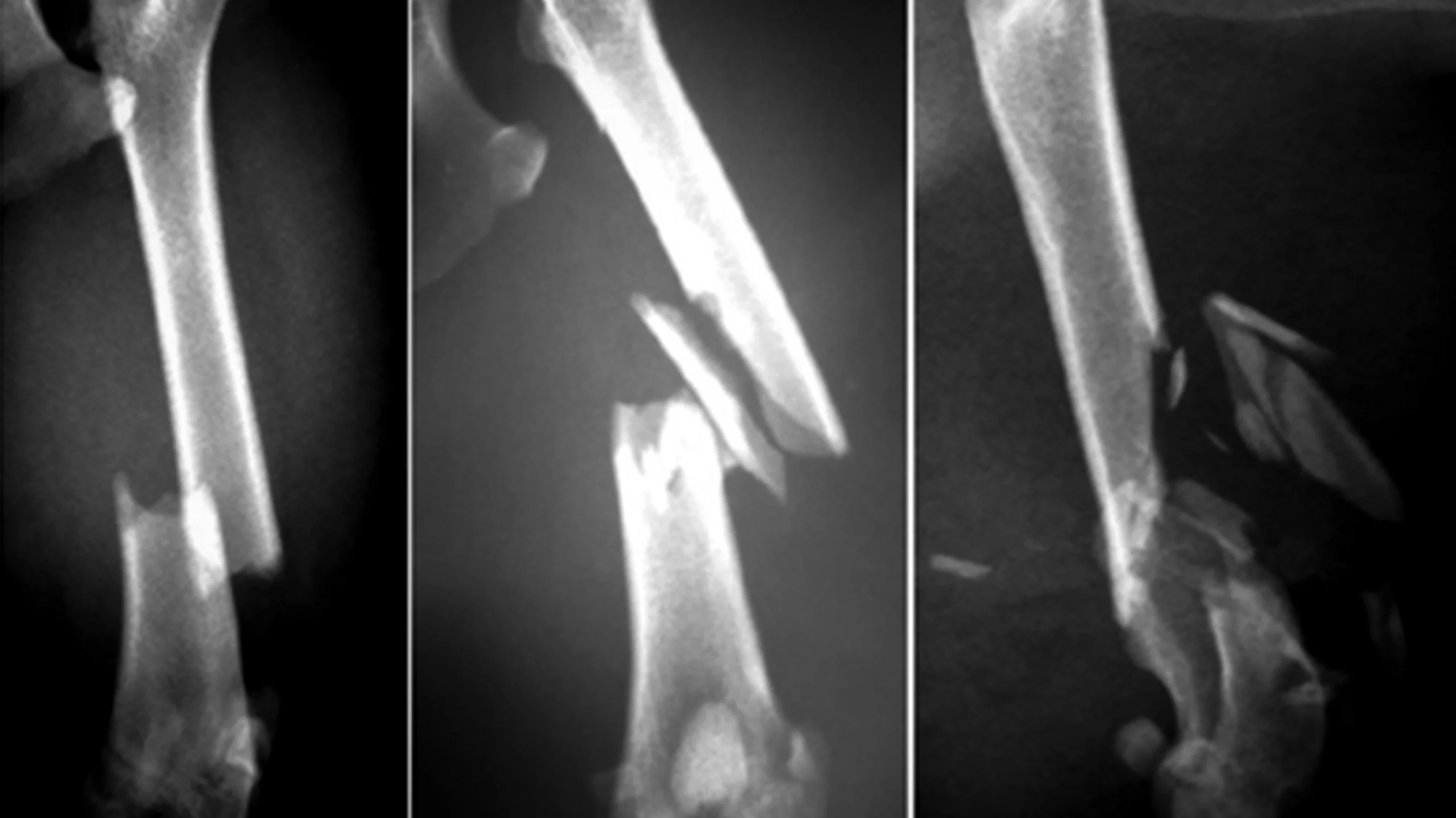 fracture